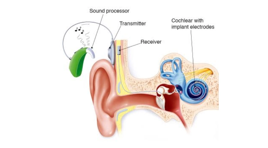 Cochlear Implant
