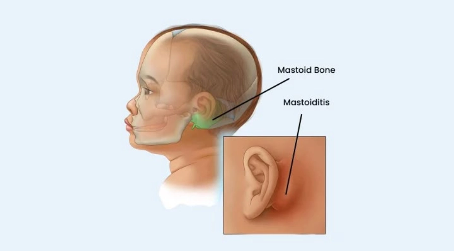 Mastoidectomy