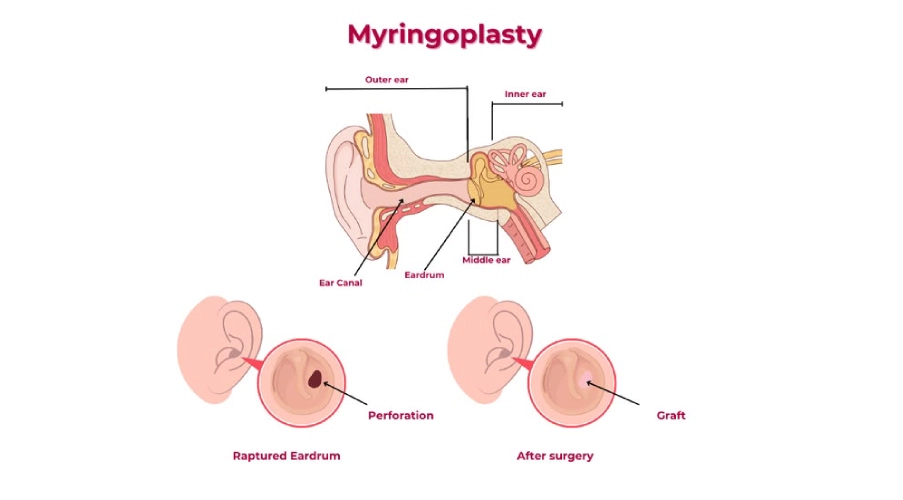 myringoplasty